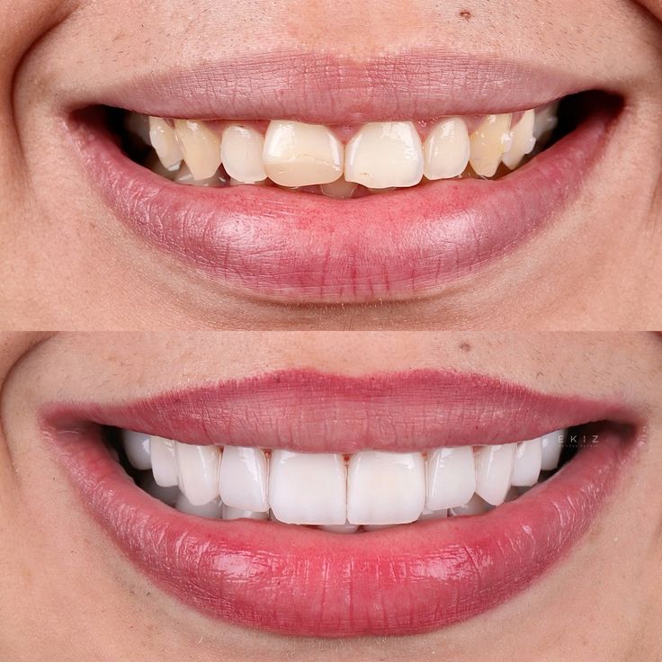 Smile Makeover