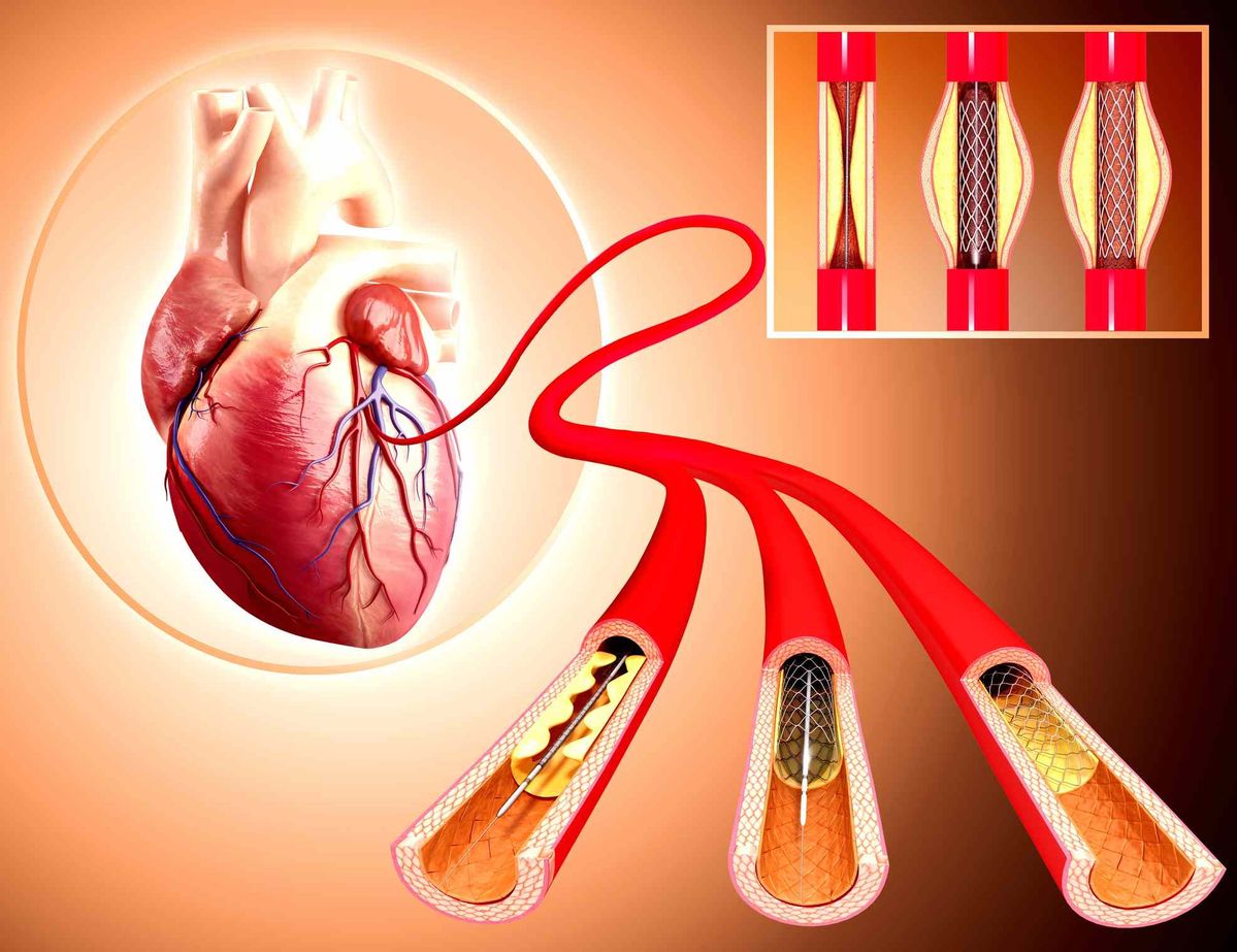 Angiography