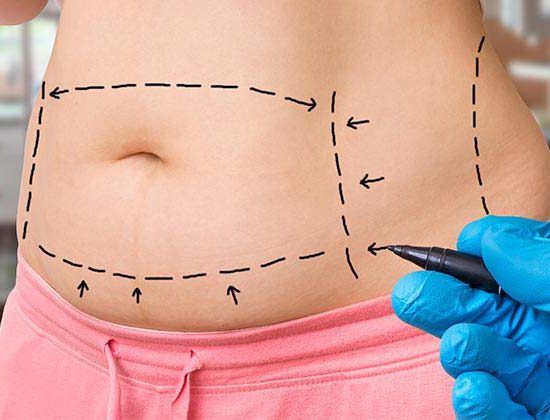 Tummy Tuck (Abdominoplasty)