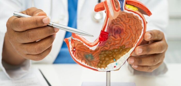 stomach-cancer stomach-cancer